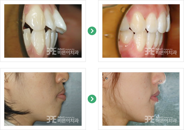돌출입교정 치료 전/후 사진