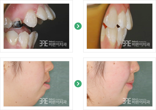 무턱 치료 전/후 사진