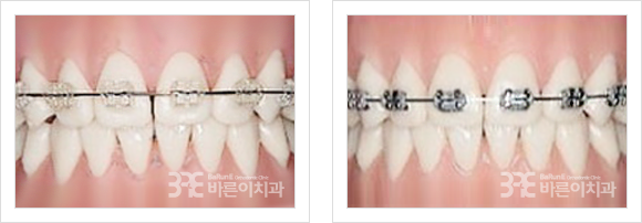 세라믹브라켓(좌)/메탈브라켓(우)