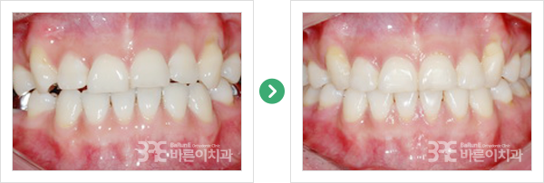 설측교정 치료/전후 사진