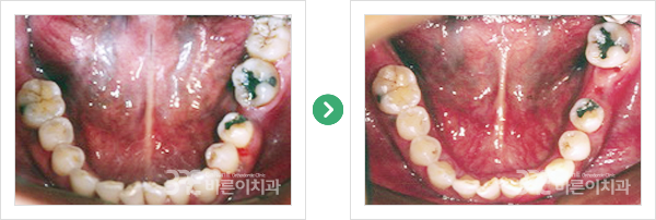 Uprighting (어금니 바로세우기)