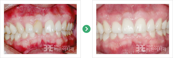 전치부 보철
