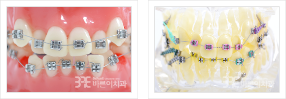 일반 메탈브라켓(교정장치)