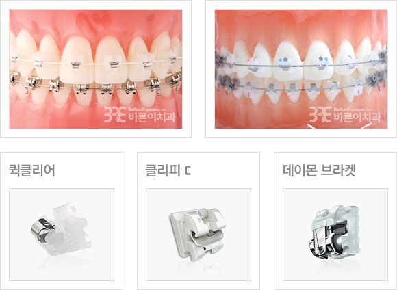 셀프(자가결찰)브라켓